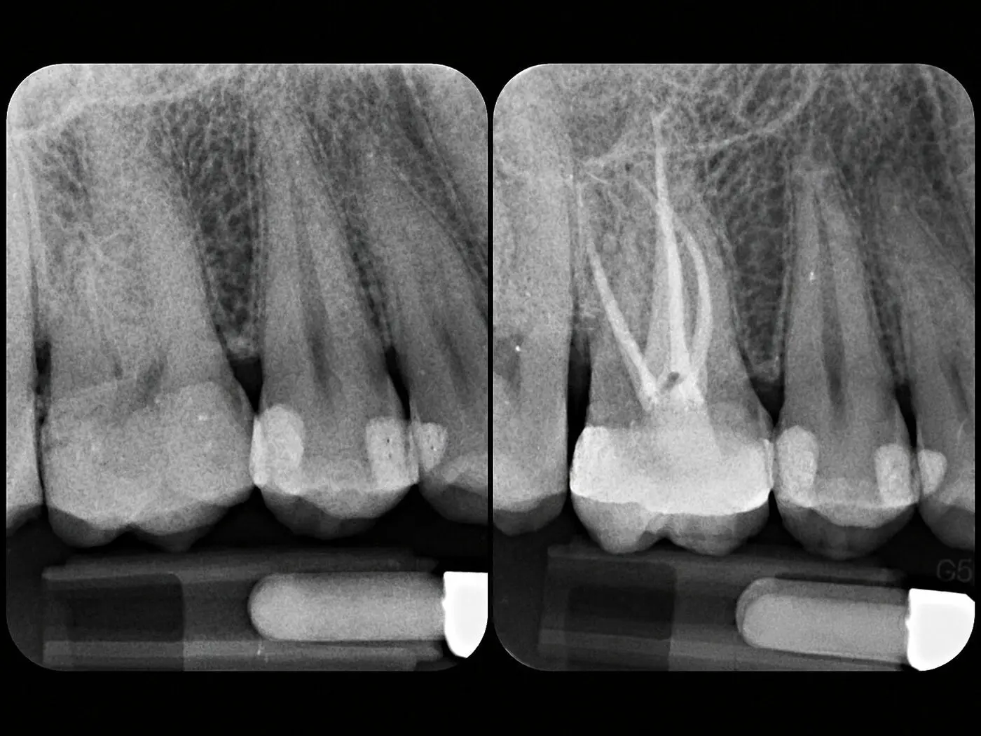 Endodonzia (devitalizzazione)